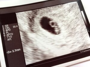 妊娠初期は注意が必要