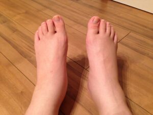 妊娠中毒症