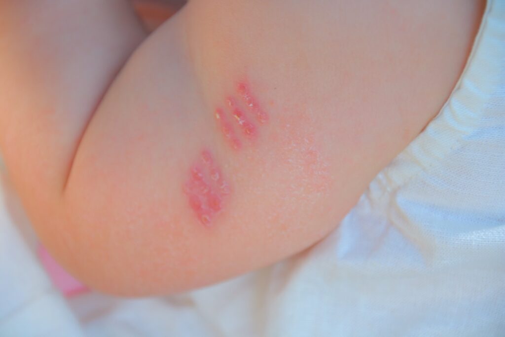 BCGの予防接種について